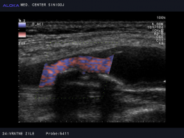 Ultrazvok vratnih žil - kalciniran plak v notranji karotidni arteriji